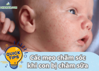Các mẹo chăm sóc khi con bị chàm sữa