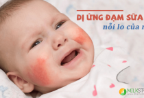 Cách nhận biết trẻ bị dị ứng với đạm sữa bò và gợi ý về loại sữa thay thế Cách nhận biết trẻ bị dị ứng với đạm sữa bò và gợi ý về loại sữa thay thế