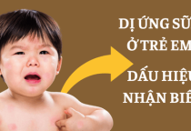 DỊ ỨNG SỮA Ở TRẺ EM – DẤU HIỆU NHẬN BIẾT - CÁCH XỬ LÝ DỊ ỨNG SỮA Ở TRẺ EM – DẤU HIỆU NHẬN BIẾT - CÁCH XỬ LÝ