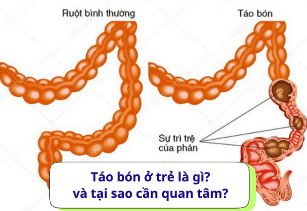 3 Cách trị táo bón cho trẻ mẹ nào cũng nên biết