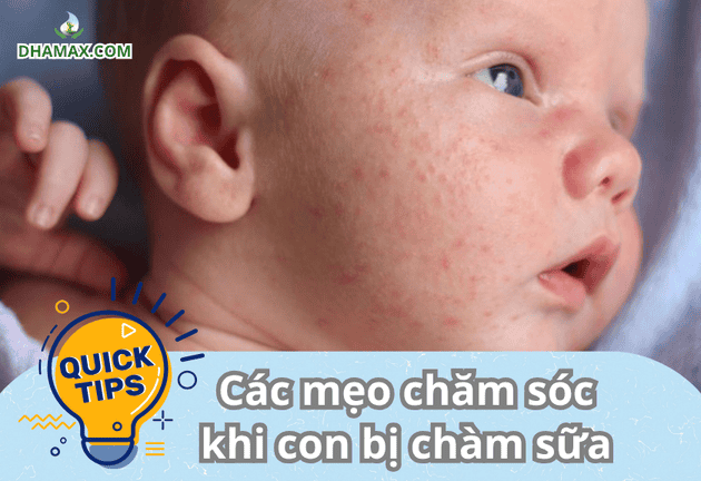Các mẹo chăm sóc khi con bị chàm sữa