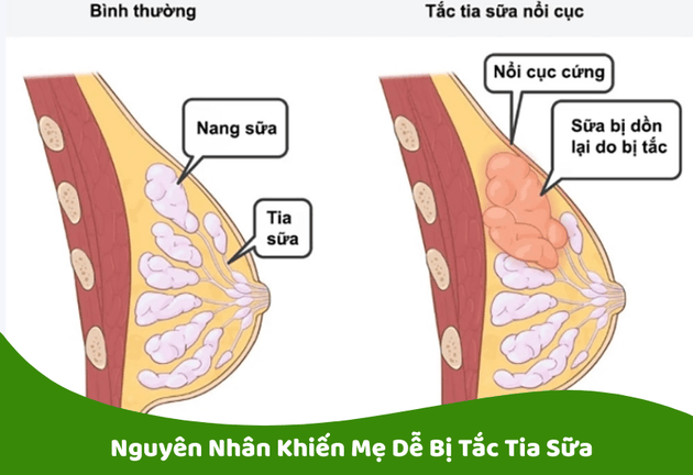 Cách Thông Tắc Tia Sữa Cho Mẹ Sau Sinh
